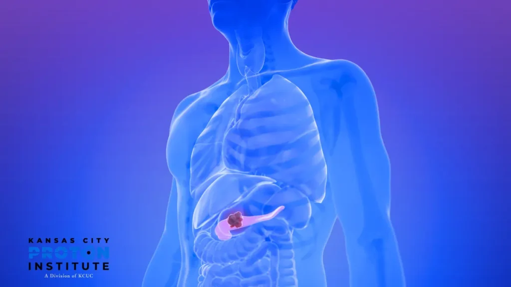 Understanding Pancreatic Cancer KCPI November 2025
